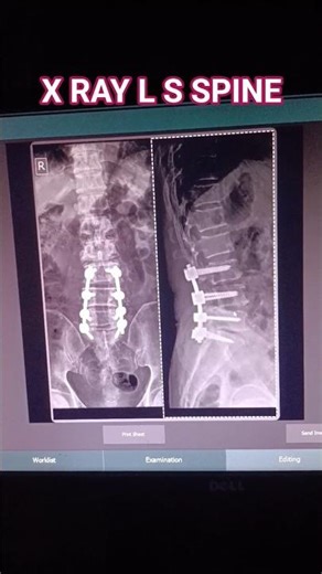 x ray ls spine। x ray l s spine। x ray lumber spine। x ray spine। x ray dl spine। x ray #anatomy