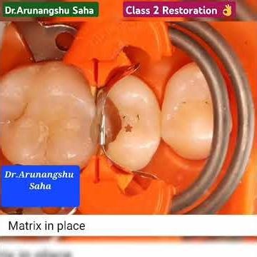Dr.Arunangshu Saha, Class 2 Restoration, 😁👌👌👌👌👌🕺