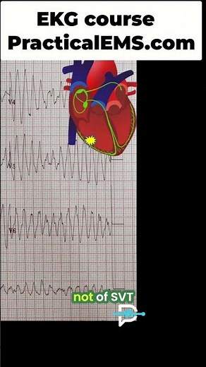 EKG: Differentiate SVT vs VT with Aberrancy, Save Lives! #shorts