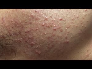 So Many Pimples! Deep Facial Cleaning ASMR #560 P1