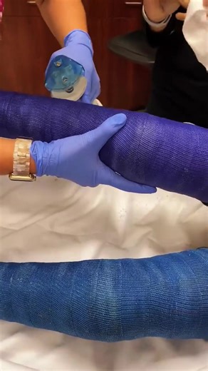 Panic Scared Look The Doctor Cut Removal Cast Broken Leg Help Poor Child 😱 #castremoval #cutting #help #brokenleg #removal