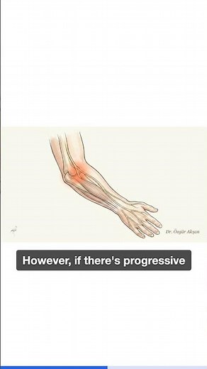 Cubital Tunnel Syndrome: Nerve Compression at the Elbow and the Surgical Decision | Dr. Özgür Akşan