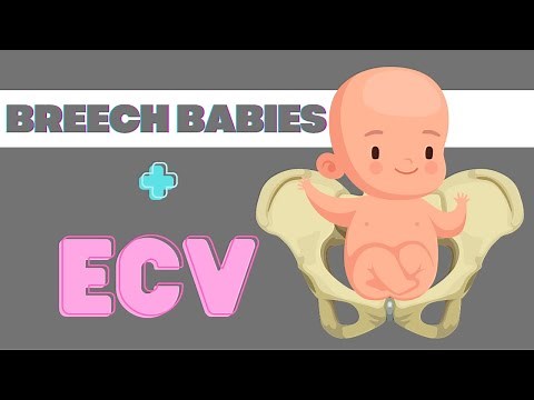 Is Your Baby Breech? (Here’s Some Options!)