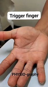 Trigger finger | PHYSIO-graphy