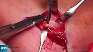 Cavus Foot: Peroneus Longus to Brevis Transfer