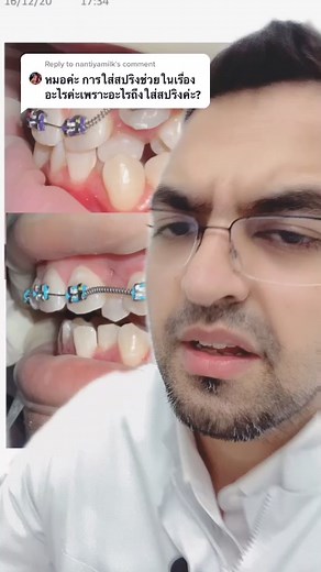 Reply to @nantiyamilk ทำไมต้องใส่สปริงจัดฟัน? #หมอฟัน #หมอวิก #จัดฟันที่smilebox #smileboxclinic #จัดฟัน #สปริงจัดฟัน #วิถีคนจัดฟัน