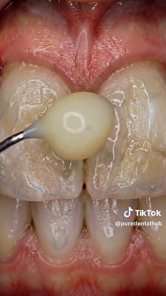 Cracked Front Teeth Fixed: Bonding, Crowns, & Root Canals