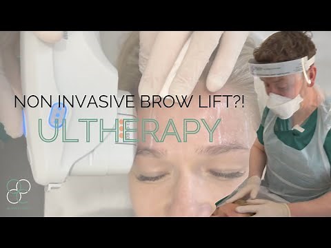 Non- Invasive *BROW LIFT* with ULTHERAPY... Does it *ACTUALLY* work ?