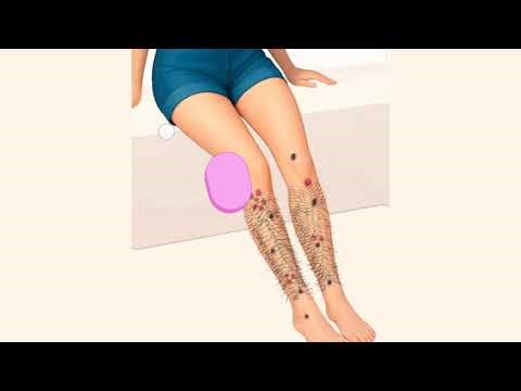Giant Blackhead Extraction: ASMR - Satisfying Skin Care
