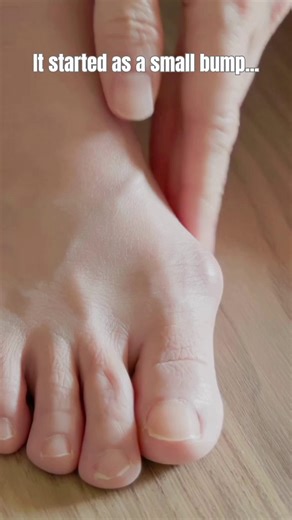  Bunions: The Plot Twist Nobody Asked For!  Did you know that...