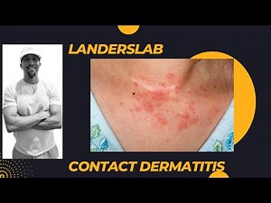 Contact Dermatitis