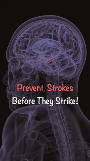 How to Prevent Stroke? Stroke Prevention Guide | Control Risk Factors & Protect Your Brain |Dr Dibya