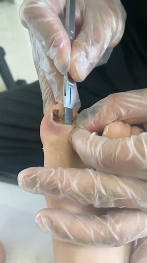 65K views · 168 reactions | #Reels Top Removal & Cutting Old & Long Big Ingrown Toenail DIY Designs Art Toenail Roomb VCD69 | Atlas Professional Risk Management | Facebook