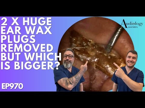 2 X HUGE EAR WAX PLUGS REMOVED. BUT WHICH IS BIGGER? - EP970