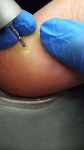 Pimple Extraction on Knee: Step-by-Step Guide