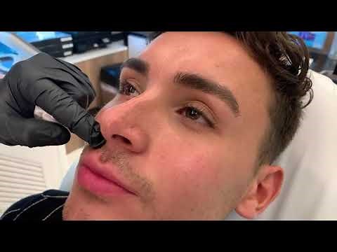 MALE RUSSIAN LIP "KEYHOLE POUT" PLUMPING WITHOUT LOOKING OVERDONE USING VOLLURE | Dr. Jason Emer