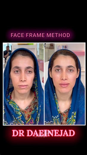 ‎دكتر فرزاد داعى نژاد‎ on Instagram‎: "⁨ تزریق فول فیس برای خانم مریم‌… تغییر زیاد اما در طبیعی ترین حالت ممکن براشون ایجاد شد …هیچگونه ادیت فیلتر و میکاپی ندارند …منتظر نظرات شما هستم🌹🙏 #دكترفرزادداعى_نژاد #فول_فيس #فيس_فريم #تزريق_ژل #تزريق⁩"‎