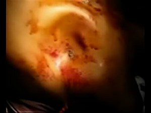 Flail Chest with Paradoxical Motion