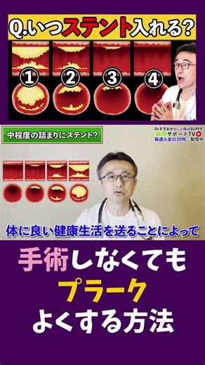 ステント手術せずプラーク改善【動脈硬化】心臓のステント治療メリットと危険性を正しく理解しよう！循環器内科医が解説 #すぎおかクリニック #船橋市