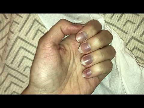 Blue fingernails and feeling very cold 24F – Cyanosis? Raynaud syndrome? (31/3/2020)