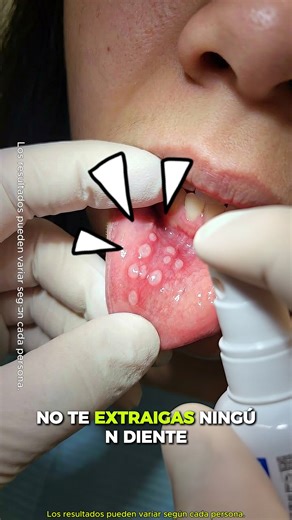 Understanding Cavities: Prevention and Treatment Tips