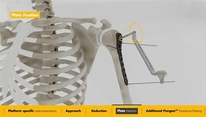 Pangea Proximal Humerus Plate Surgical Animation