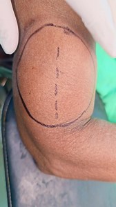 Intramuscular Lipoma | Dr. Khaled Hasan Milu