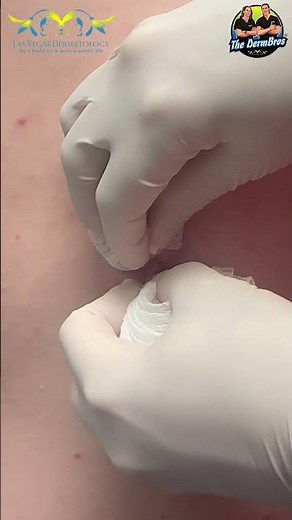 Squirting Cyst 💦 Incision & Drainage with Dr. H.L. Greenberg at Las Vegas Dermatology®