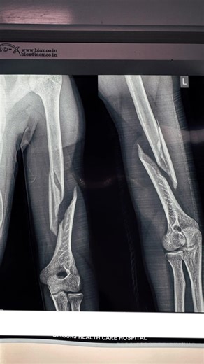 Understanding Humorous Fractures in Young Adults