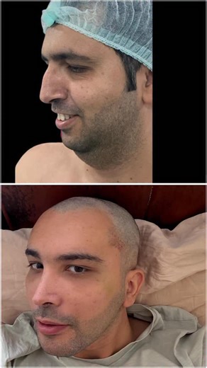 Op.Dr Melih Canlı on Instagram: "Full facelift combined with revision rhinoplasty. Performed in two stages for safety and precision. Healing in progress — results already telling the story. Stay tuned for the final chapter.#rhinoplasty #naturalresults #facelift #necklift"