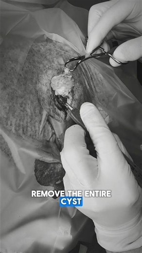 What’s Inside a Cyst? Dr. Jochen’s Careful Extraction