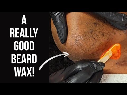 Women With Facial Hair Is Called Hirsutism! | Wax Update! #FollowUp #BeardWax #chinwax hinwax