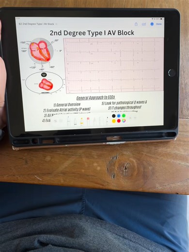 Mobitz I #ecg #ekg #cardiac#learnontiktok