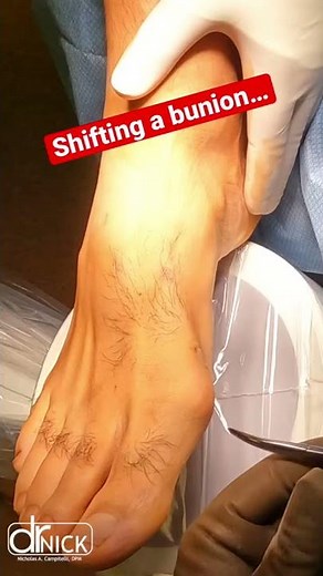 AMAZING WAY TO FIX A BUNION! 😳😱 #shorts #bunion