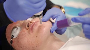 CO2 Laser Resurfacing