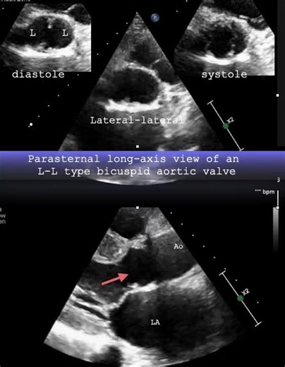 Parasternal long axis view of an L L type bicuspid aortic valve