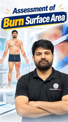 Assessment Of Burn Surface Area🏥#norcet11 #rrbnursingsuperintendent #choexam #nursingmcq #sagarsir