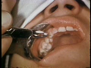 INTRAMAXILLARY MULTIPLE LOOP WIRING IN TREATMENT OF JAW FRACTURES