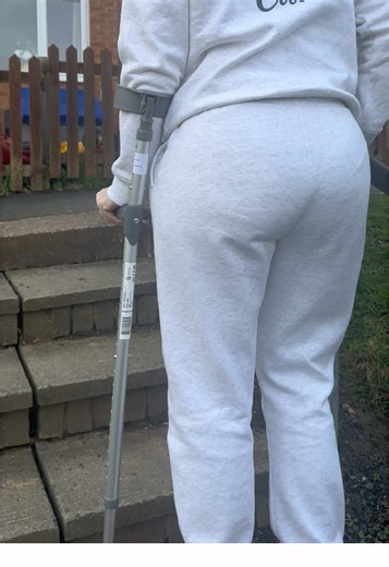 After 2 hip surgeries, these small step means everything #hiparthroscopy #arthroscopy #tornlabrum #labraltear #fai