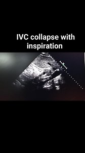 Significant IVC collapse with inspiration | Ahmed Mohsen | Facebook