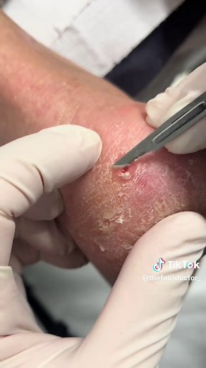 Effective Corn Removal for Happy Feet