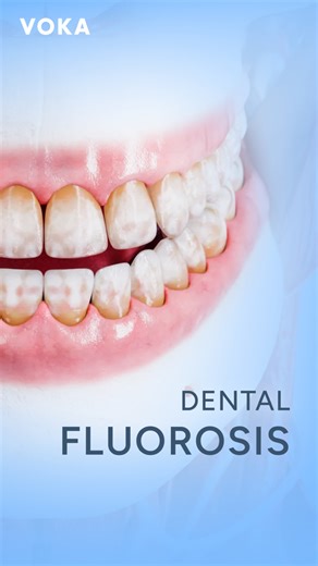 🦷 Dental Fluorosis: When Too Much Fluoride Affects Enamel Development Dental fluorosis occurs when excess fluoride exposure interferes with enamel formation during early childhood—before the age of six. 💧 Main risk factors include: Long-term consumption of drinking water containing more than 1.5 mg/L of fluoride Swallowing large amounts of fluoride-containing dental products at a young age 🧬 Severity matters The extent of dental fluorosis depends directly on the fluoride concentration and the