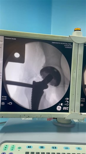 Pankaj Walecha on Instagram: "This hook goes around the neck, and it helps me check lateral stability of the hip. After placing the implant, we don’t just look at X-rays. We physically move the joint to see how it behaves in real time. Checking lateral movement helps confirm that the hip is stable, balanced, and less likely to dislocate once the patient starts walking. This step is important because a well-balanced hip is what gives patients confidence in daily movements like standing, walking, 
