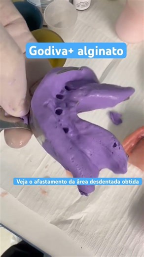 Moldagem mista: godiva+alginato #dentista #odontologia