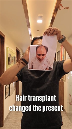 Hairline Transformation | The Secret to a Younger Look | Hair Transplant Before & After