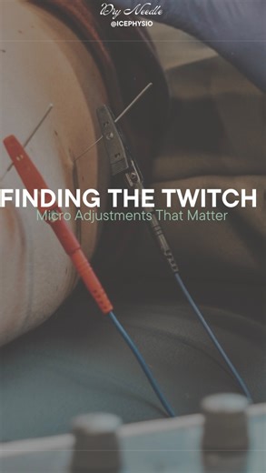Let’s walk through the small but critical adjustments that make all the difference in Dry Needling outcomes. We had a decent response in pronator, but the flexor group wasn’t giving us what we wanted, so we: ➡️ Dialed the stim down ➡️ Performed a live reposition by pulling back changing our angle ➡️ Re-entered conductive tissue to restore proper activation Once we were back in the right tissue bed, the twitch response immediately improved; cleaner, stronger, and far more clinically useful. These