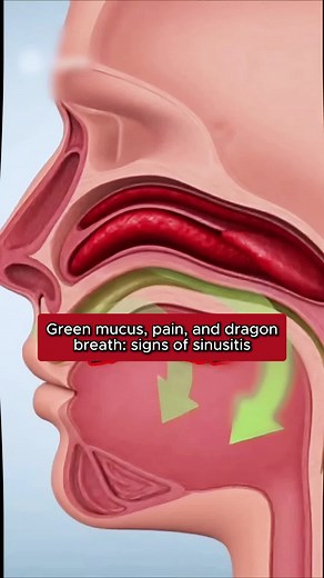 Signs of Sinusitis: Understanding Symptoms and Causes