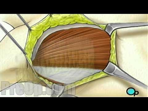 Mastectomy Radical Breast Surgery Patient Education Medical Video