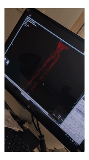 CT Lower Limb Angiography☢️ #CT_Scan #UnitedImaging #Radiograher #CT_Technician #AasavHospital