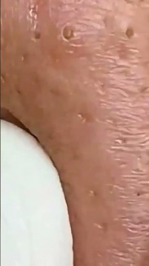 Blackhead Removal With Sac Dep Spa #acne​ #blackheads​#whiteheads​ #Treatments​ #pimple​ #SacDepSpa